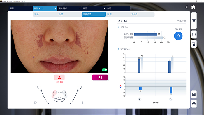 Detaljno se analiziraju bore oko čela, očiju i nazolabijalne oblasti.